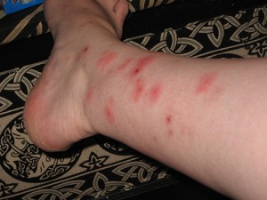 bed bug bites